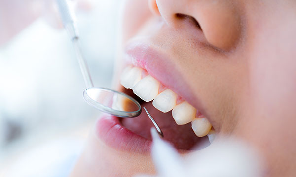歯周病治療のイメージ